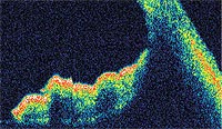 This anterior chamber angle is viewed in a pigment dispersion patient