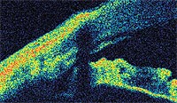 This anterior chamber angle is viewed in a low hyperope