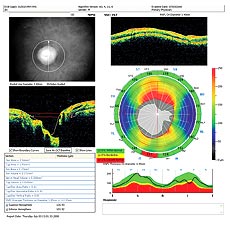 The Optovue NMH4 printout (from a spectral domain OCT) also shows a small focal loss at the rim (seen in red in the IT1 sector) as well as focal loss on the TSNIT curve