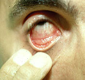 Herpes simplex blepharoconjunctivitis