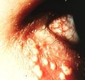 Herpes simplex blepharoconjunctivitis