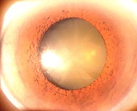 A nuclear cataract