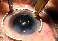 This 59-year-old woman with a history of cataracts and 2 D of with-the-rule astigmatism underwent cataract surgery with implantation of an accommodating IOL