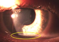 Note the appearance of the limbal relaxing incisions postoperatively