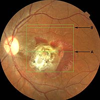 This fundus image shows the extensive macula scar surrounded by areas of hemorrhaging