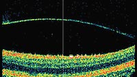 This image demonstrates the ability of SD OCT to capture the vitreous (posterior hyaloid) as we have never been able to see with such clarity