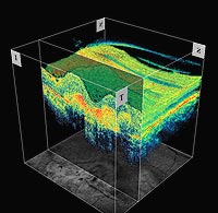 This 3D image clearly displays areas of elevation throughout the macular region