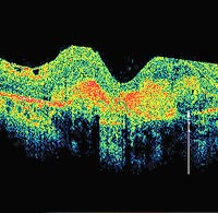 This SD OCT image reveals areas of high reflectance (shown in red), which can be attributed to either the macular scar or a CNVM, or more likely both