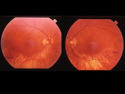 Patient 1, fundus exam: