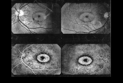 Patient 2, fundus exam