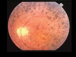 Classic RP fundus