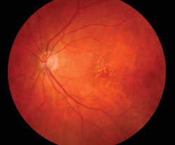 Scenario 1: An 88-year-old male with neovascular AMD wonders if Avastin injection may benefit his condition.