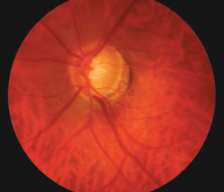 Scenario 2: A 61-year-old female with primary open-angle glaucoma wonders why she is not responding to prostaglandin analogs.