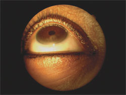 Limbal stem cell deficiency in a contact lens wearer.