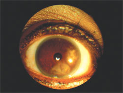 Limbal stem cell deficiency in a contact lens wearer.