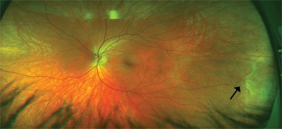 Figure 1. This 26-year-old study subject had no symptoms and no medical or ocular history.