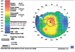 Figure 1b. Instantaneous and local radius of curvature map