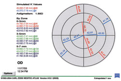 Figure 1d. Keratometric map