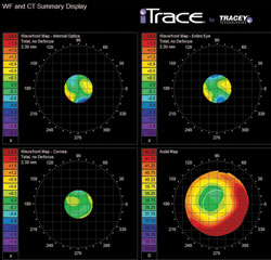 Figure 2. The wavefront and topography display of the iTrace unit