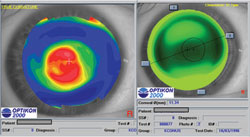 Figure 4. A contact lens fitting module may facilitate fitting irregular corneas.