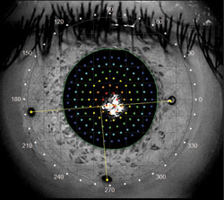 Figure 5. Wavefront correction may be incorporated into a contact lens.