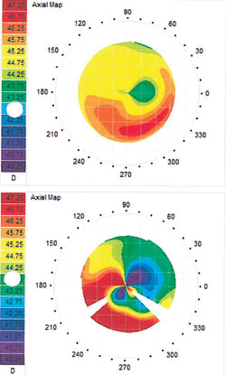 Figure 6a. Dry eye may manifest as irregular astigmatism(left)