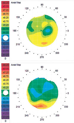 Figrue 6b. Treatment of the eye(right, post-treatment)