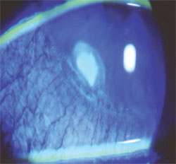 Peripheral corneal ulcer