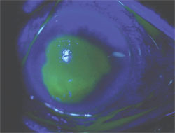 A large central bacterial corneal ulcer.