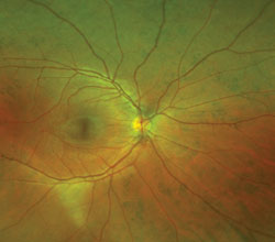 The Optomap images revealed that the lesions were visible in all quadrants of both eyes.