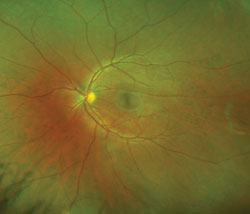 The Optomap images revealed that the lesions were visible in all quadrants of both eyes.