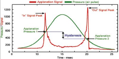 Figure 1. Waveform (red) generated by the Ocular Response Analyzer in response to noncontact applanation (green)