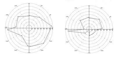 Figure 2. The field loss in the left eye was confirmed with automated Goldman perimetry using a size III 4E white target.