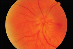 Figure 1. On dilated fundus examination, the retina and optic nerve appeared healthy in the right eye.