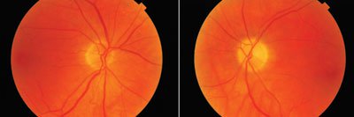 Figure 4. Fundus exam revealed a normal optic nerve in the right eye with a sector optic atrophy in the left eye.