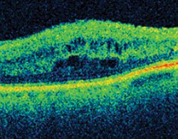 Figure 1. Ocular coherence tomography appearance of cystoid macular edema in a diabetic patient. Best corrected vision is 20/200.