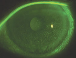 Figure 1. Dense superficial punctate keratitis can occur secondary to dry eye syndrome.