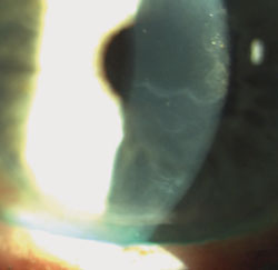 Figure 2. Anterior basement membrane dystrophy presents with the classic “mare’s tail defect.”