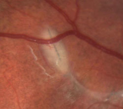 Figure 3. A high magnification photograph of the lesion was helpful in identifying the presence of a nematode/maggot.