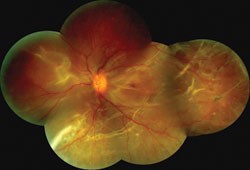 Figure 1. A mosaic of the left posterior pole. Notice the fibrotic bands and focal areas of vascular tortuosity. In addition, notice the tractional folds near the fovea.