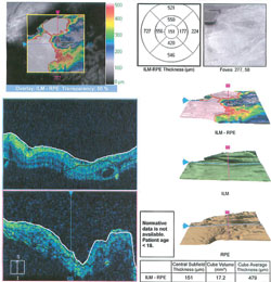 Figure 2. OCT images of the left macular region. Notice the marked areas of focal retinal elevation (especially as shown with the 3-D module).