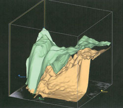 Figure 3. OCT images of the left macular region. Notice the marked areas of focal retinal elevation (especially as shown with the 3-D module).