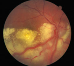 Retinal capillary hemangiomas