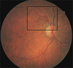 Fundus exam revealed unusual retinal vessels superior temporal to the optic disc and a macular hole in the right eye.