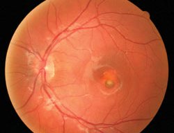 Follow-up fundus exam after an anti-VEGF injection in the left eye.