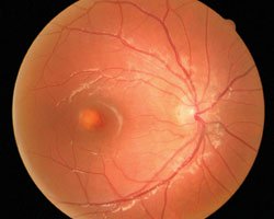 Fundus exam showed an irregular foveolar reflex with an egg yolk-like lesion.