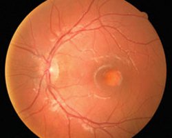 Fundus exam showed an irregular foveolar reflex with an egg yolk-like lesion.