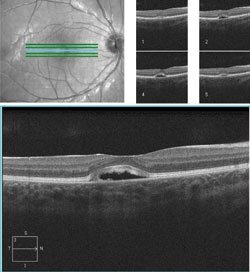 OCT showed an intrapigment cyst or cavity in both eyes.