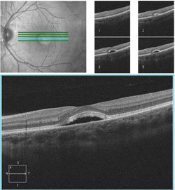 OCT showed an intrapigment cyst or cavity in both eyes.