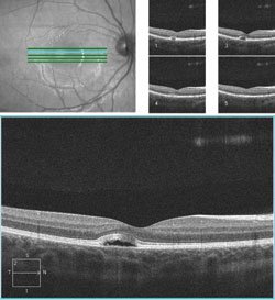 A small cavity in the subretinal space in the right eye 